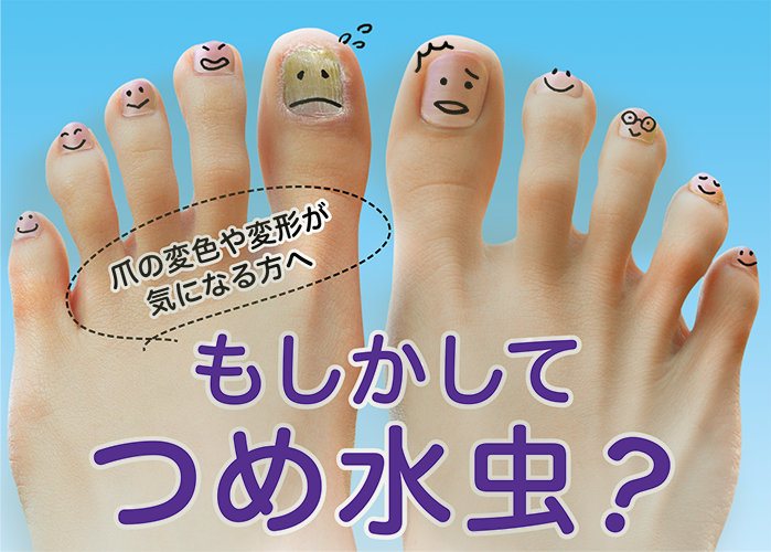 水虫は赤ちゃんや子どもにもうつる？家庭内感染を予防する方法7選キッズドクターマガジン