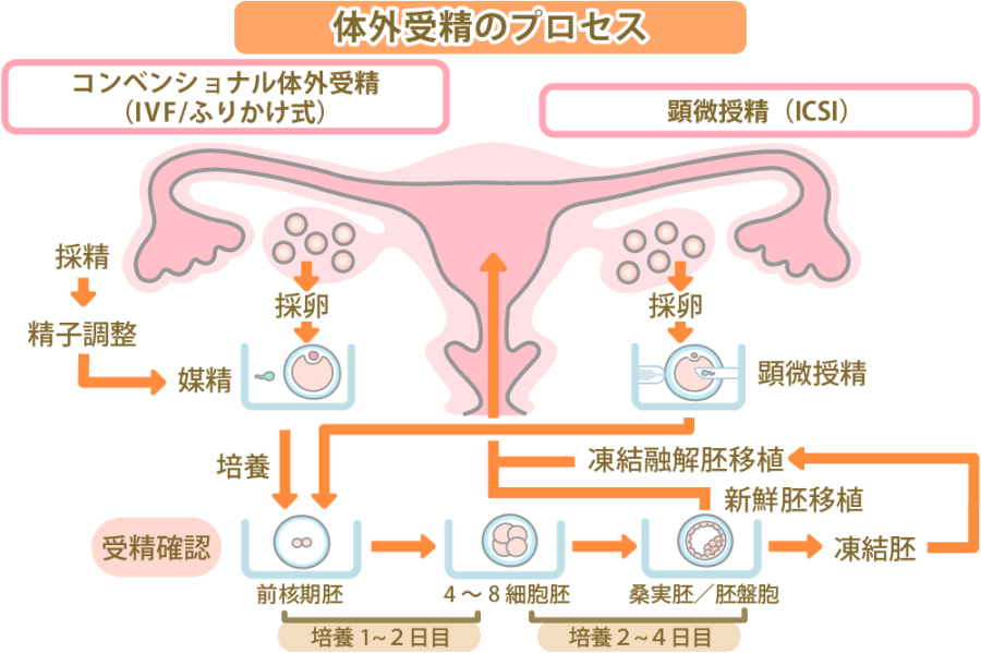 人工授精 AIH と体外受精 IVF の違いとは?不妊治療の流れを解説にしたんARTクリニック