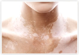 尋常性白斑の原因と治療法漢方のアオキ薬局