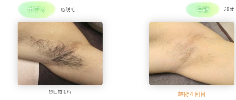 ワキ脱毛福岡市東区二又瀬の理容室ヘアーサロンダイマル