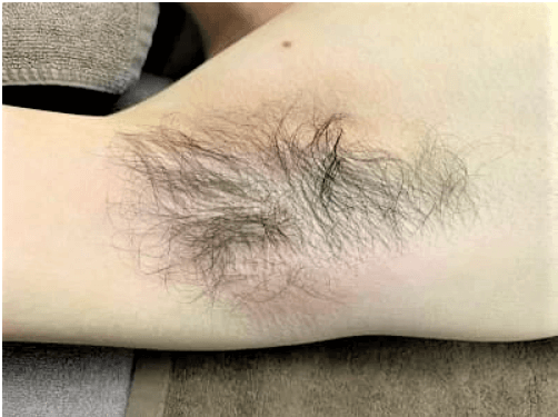 脇毛を薄くするには？濃くなる理由やツルツルにする6つの方法 - セルフ脱毛サロンONESELF ワンセルフ無人都度払いペア入室