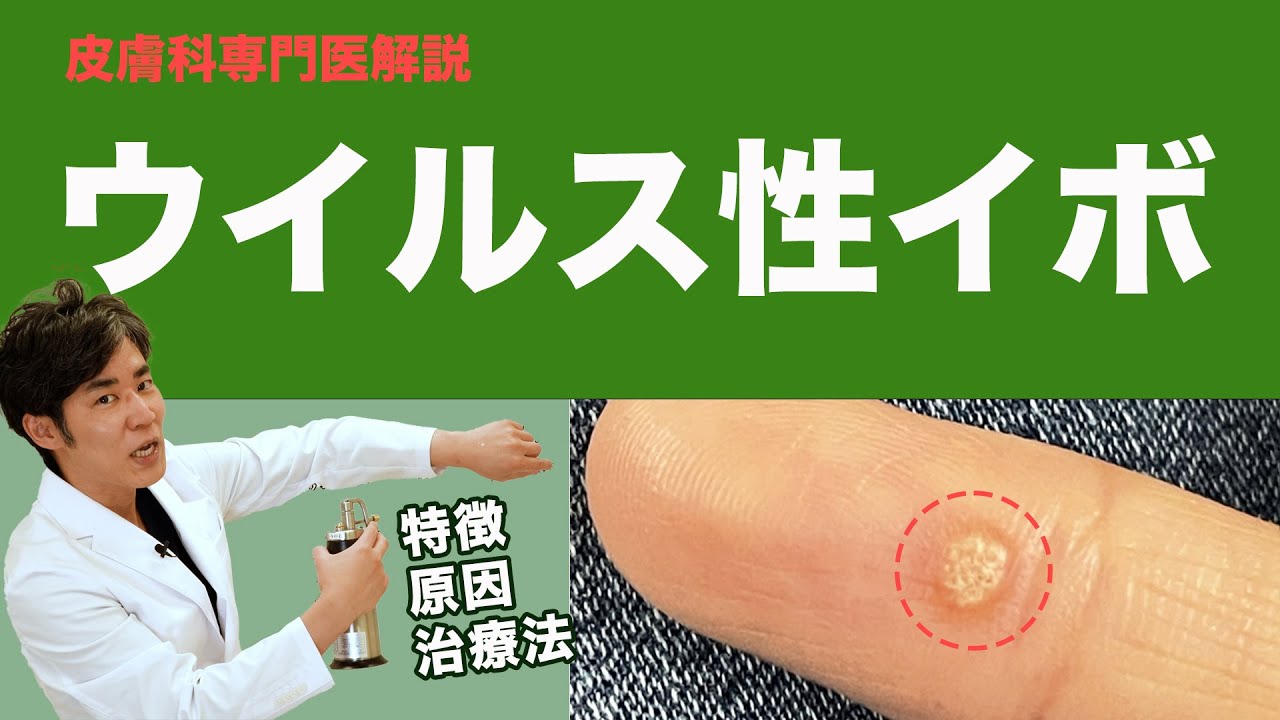 尋常性疣贅 イボ の代表的な治療法を確認しよう薬剤師コラムm3.com
