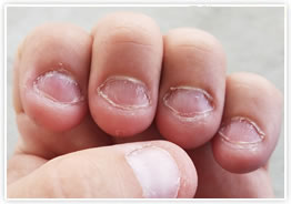 精神科のような心のケアはしていませんが、爪噛みのお爪は変わりました。広島 深爪専門ネイルサロン