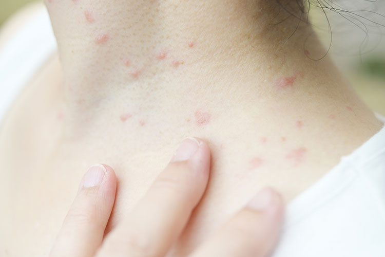 アトピー性皮膚炎山梨県韮崎市の皮膚科・アレルギー科なら「さおり皮ふ科クリニック」