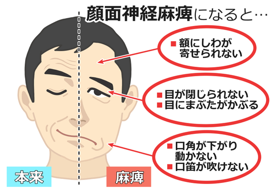 脳卒中後遺症 顔が思うように動かない！顔面神経マヒって何？ - 脳梗塞Labo マヒリハ