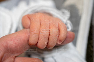 脂漏性皮膚炎湿疹、皮膚炎⑤看護roo! カンゴルー