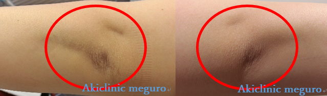 วิธีเปลี่ยนข้อศอกดำด้านให้เนียนสวยใน 7 วัน💖✨