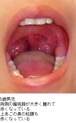 こどものいびき・睡眠時無呼吸症候群 - 春日井市の坂井耳鼻咽喉科