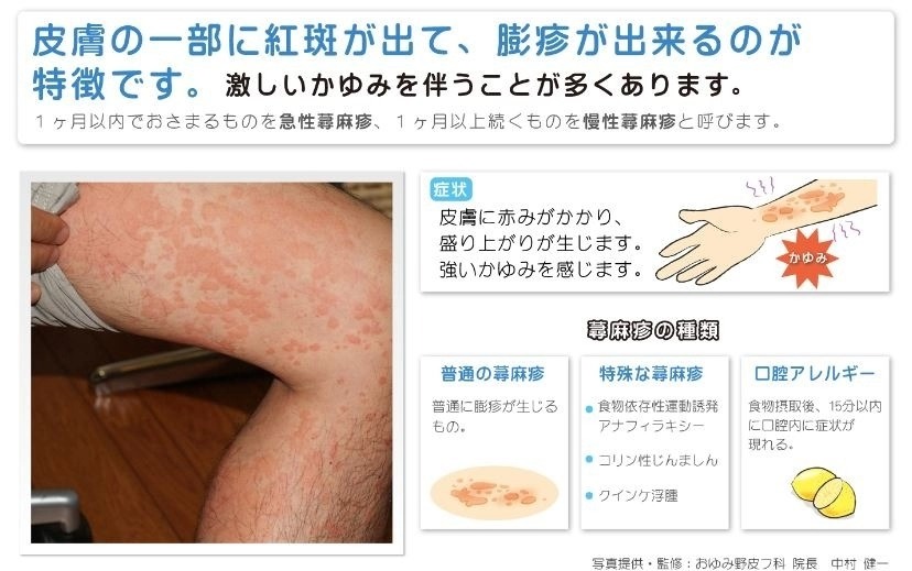 蕁麻疹の原因はストレス？湿疹との違いや治し方兵庫県川西市ことぶき皮ふ科クリニック