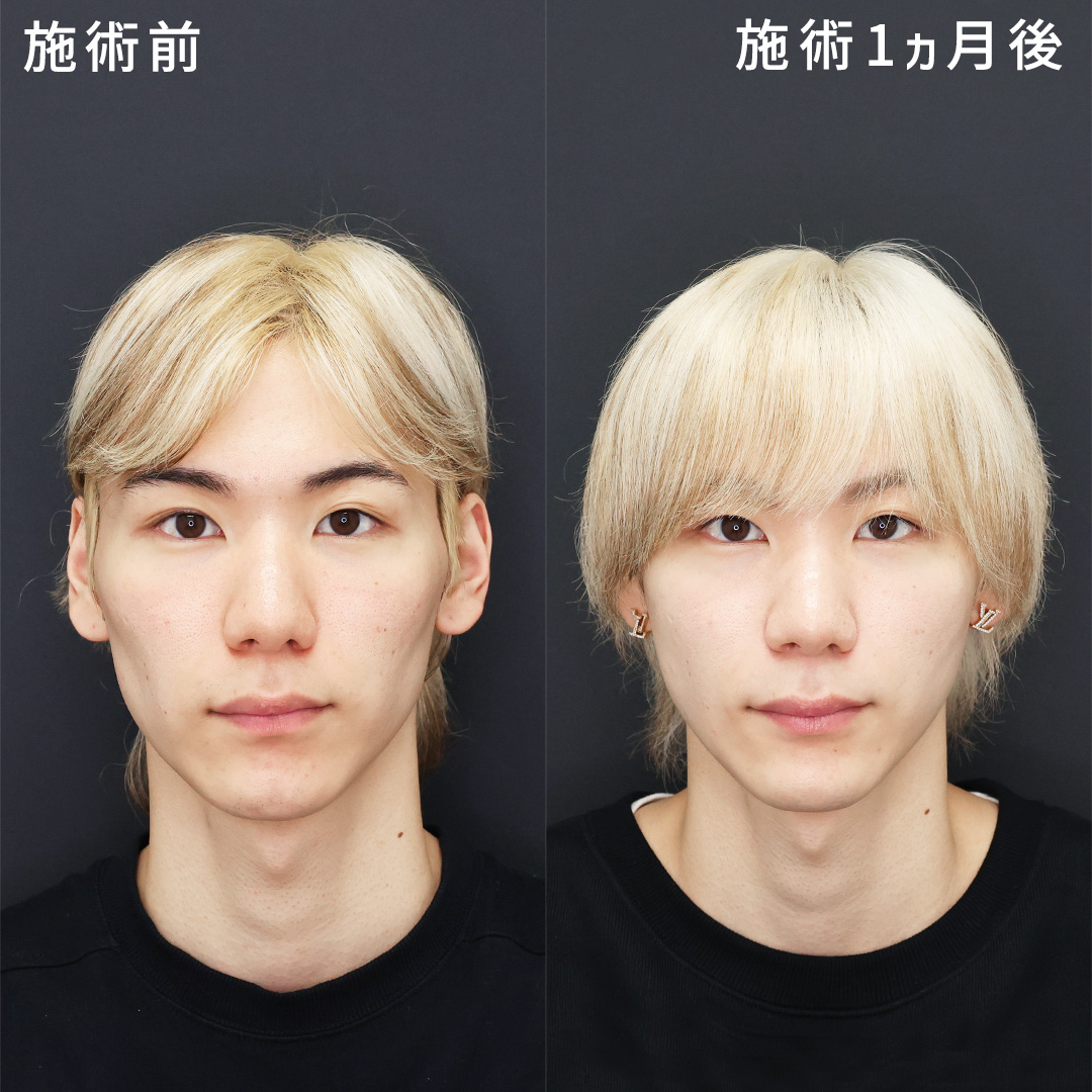 医師監修 頬骨を引っ込めるためにはどうしたらいい？頬骨が出る原因と対策を解説！公式コラム美容整形・二重整形なら共立美容外科