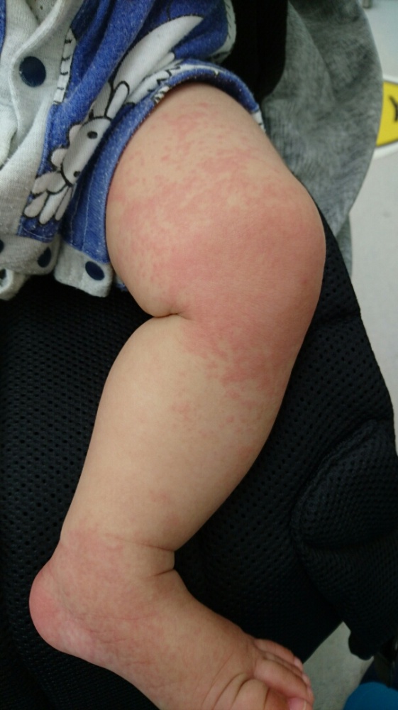 あせも 汗疹 吹田市の皮膚科もりはら皮ふ科クリニック