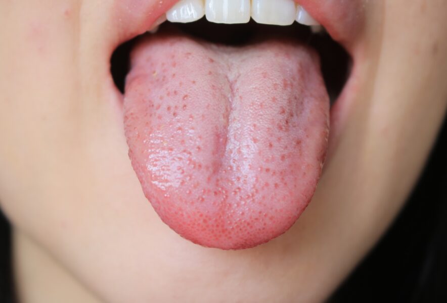 舌苔とは？３つの原因と自宅でキレイに落とす３つの対策 - 東戸塚の歯医者おかざき歯科クリニック横浜市東戸塚駅のインプラント、セラミック審美歯科、矯正歯科治療の歯医者