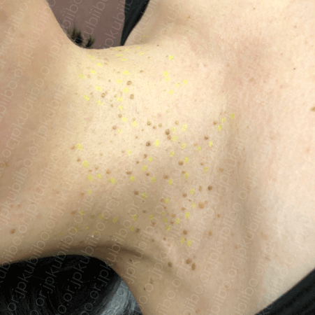 mikoメソッド 首いぼ治療- 秋田市の美容皮膚科 AdeBクリニック