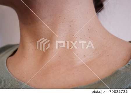 首に小さいイボが多数出来たことある人とりましたか？ - 妊娠中にイボの除去- Yahoo!知恵袋