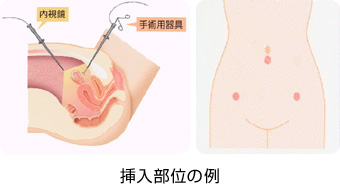Lady Care レディケア 12 帝王切開 手術跡 傷 傷跡 テープ ギネマム シリコーンゲルシート : エクセレントメディカル ヤフー店 -通販 - Yahoo!ショッピング