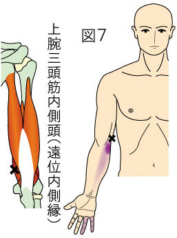 上腕三頭筋 - 野球 × 理学療法士