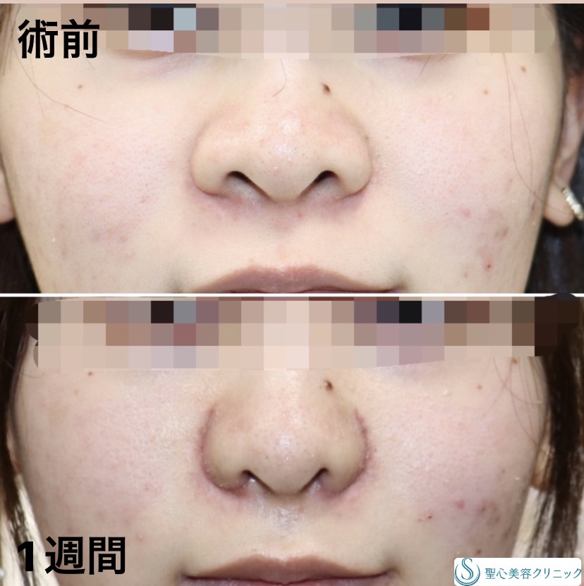 にんにく鼻整形で叶える自然な印象の鼻先ガーデンクリニック