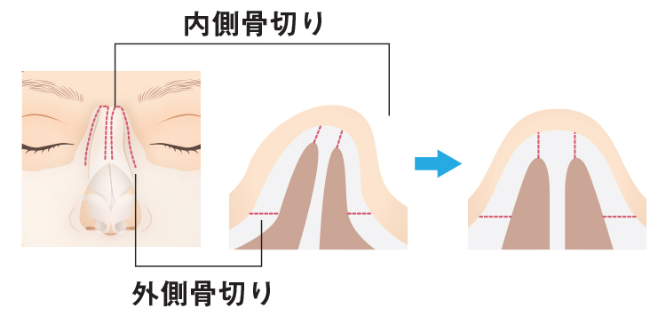 さいとう隆文_鼻・輪郭骨切り手術の症例が綺麗な美容外科医鷲鼻を残したい方の美容鼻整形 術後の腫れがまだ残る14日目。他院で前額ヒアルロン酸注入も受けておられます。美容外科鷲鼻鷲鼻修正顔面非対称顔のゆがみ斜鼻修正斜鼻修正術鼻翼縮小鼻翼