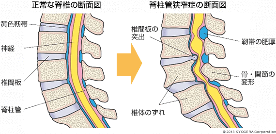 看護教員に怒られない関連図 腰部脊柱管狭窄症鳩ぽっぽの関連図ブログ