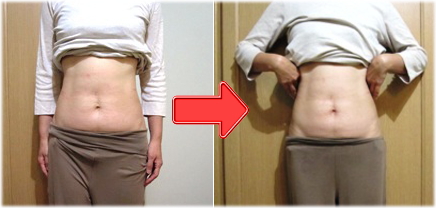 出産後のお腹のたるみを克服してビキニを着こなす秘訣 I リディアンクリニック