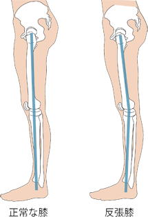 膝が逆に曲がる症状の原因と対処方法 - 足立慶友整形外科