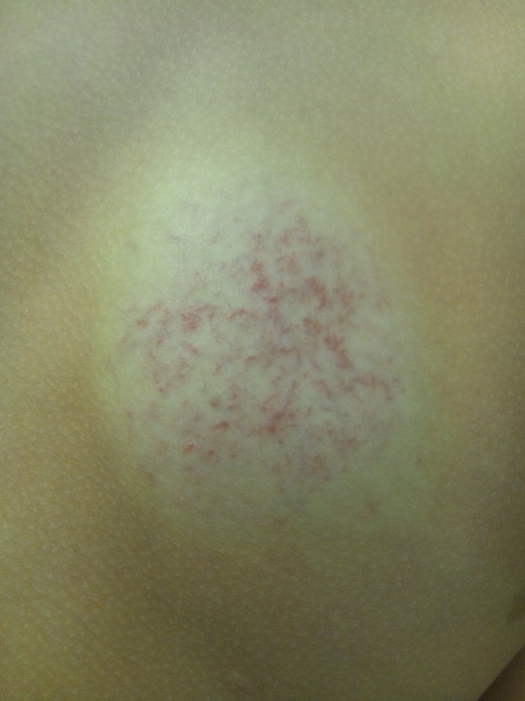 こどもの皮膚の病気│箕面市今宮の小児科│こひつじキッズクリニック