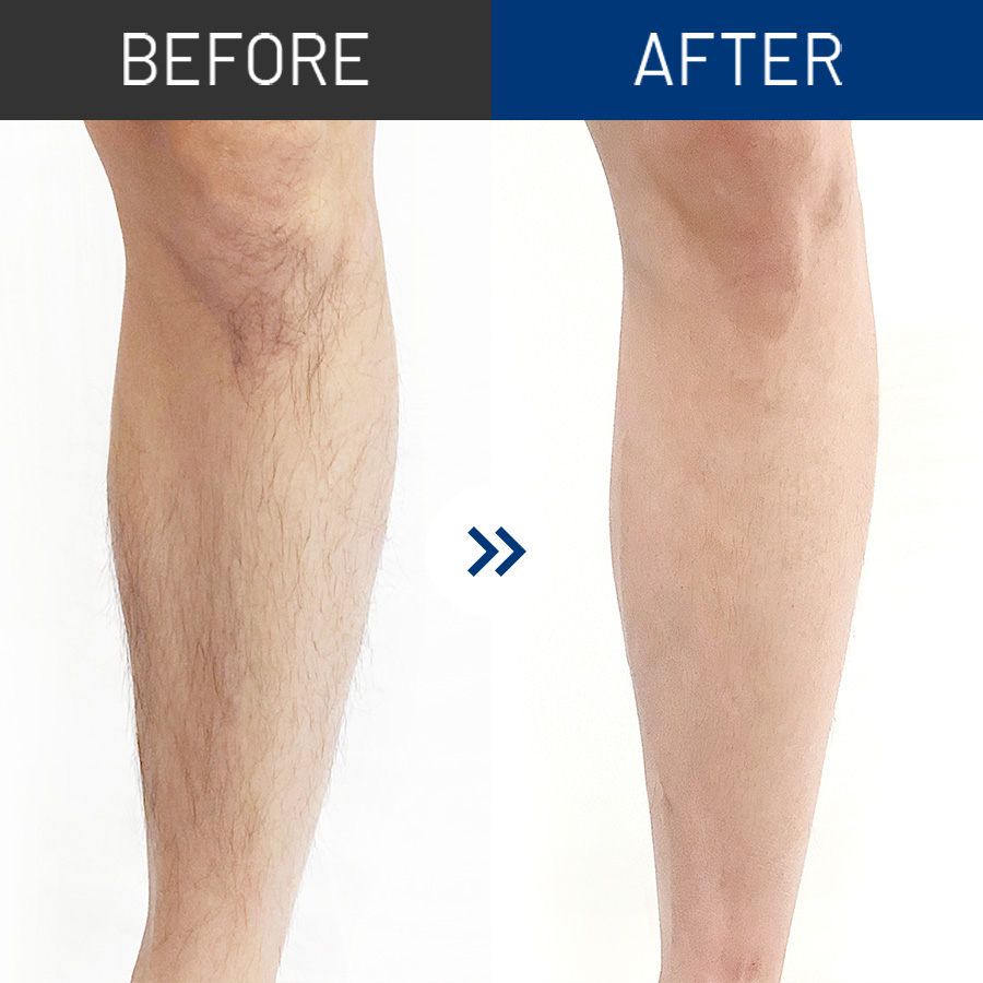 足全体脱毛セット 公式 男性脱毛のメンズリゼ