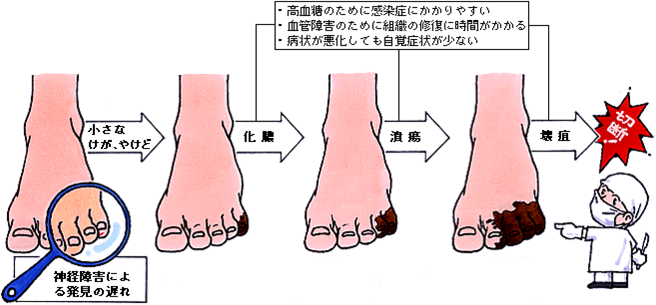 フットケア外来診療内容蒲郡市のすずりん皮膚科クリニック