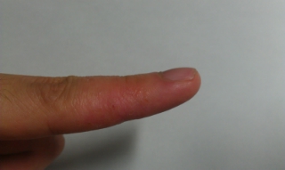 デンジャラス」ノッチの次女、完治困難な異汗性湿疹で“電流療法” 1年ごしの成果に妻も満足 「痛みの方が耐えられる」 1 2ねとらぼ