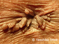 亀頭・陰茎のブツブツ コンジローマ 治療包茎手術ならエストクリニックメンズ東京 横浜・品川・町田