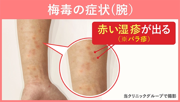 症例写真 梅毒の初期症状・治療法 初期は湿疹・じんましんのような皮膚症状皮膚・爪・髪の病気All About