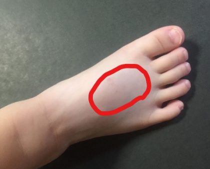 第5中足骨骨折・いわゆる下駄履き骨折と疲労骨折一般社団法人 日本整形外傷学会 骨折の解説