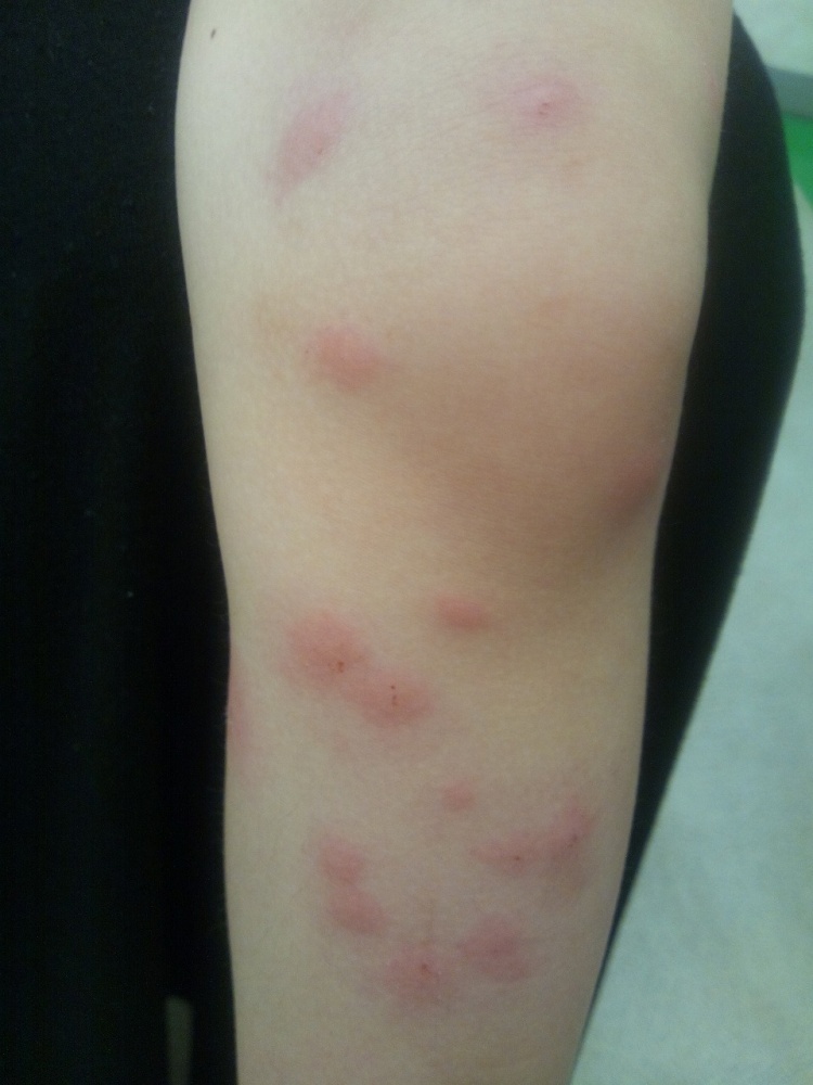 体の局所に集中している湿疹野田市 小児科 千葉県 こどもの花粉症 こどもの漢方 喘息 アトピー性皮膚炎 アレルギー 結節性痒疹たんぽぽこどもクリニック