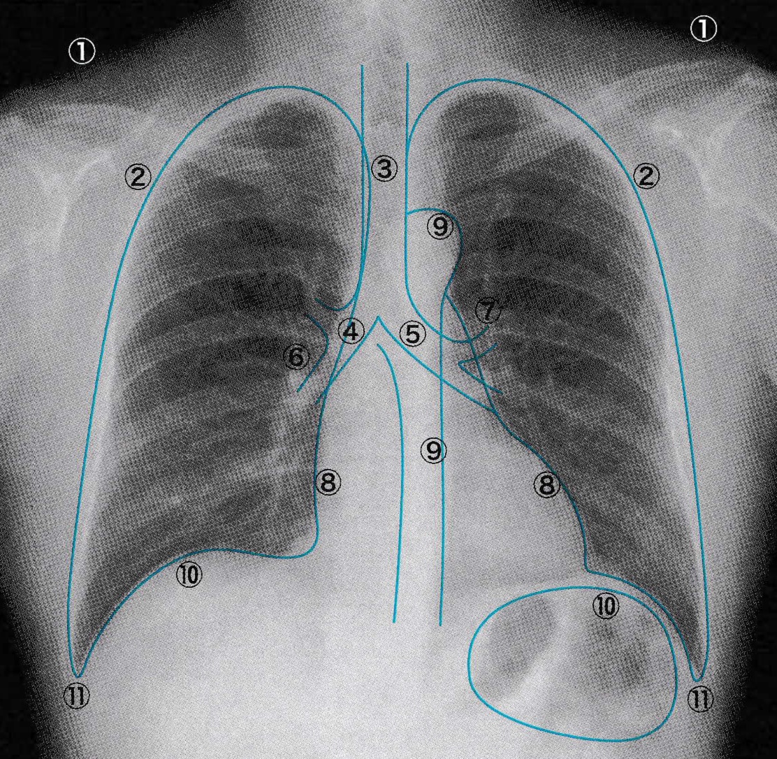 無気肺の種類や症状、検査、治療について - 日ノ出町呼吸器内科・内科クリニックブログ
