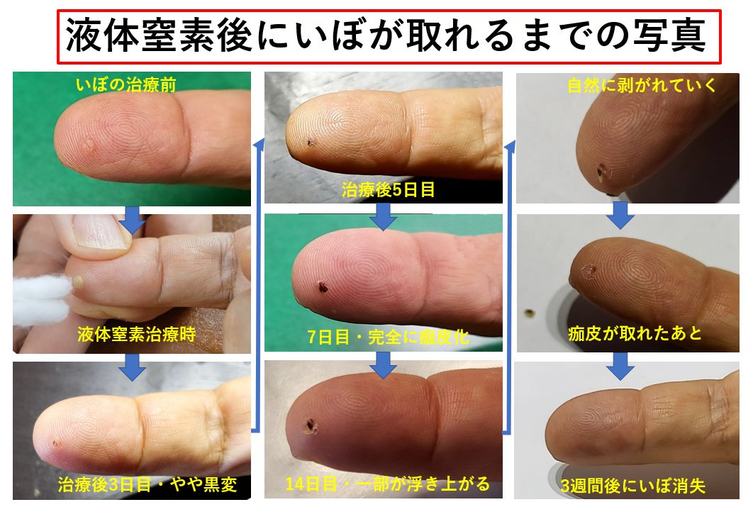 イボ 尋常性疣贅:ゆうぜい- 銀座まいにちクリニック 内科・皮膚科・泌尿器科