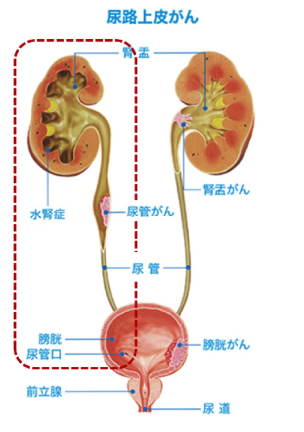 腎盂尿管がん 泌尿器科疾患について- 東京慈恵会医科大学 泌尿器科