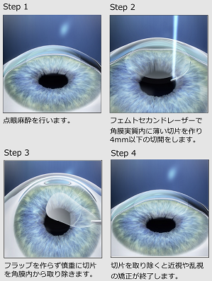乱視は矯正した方がいい？正しい矯正方法を知って悩みを解決しようアキュビュー®公式