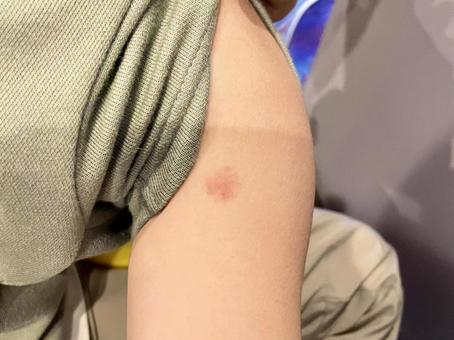 採血後のひどい内出血の写真・画像素材-Snapmart スナップマート