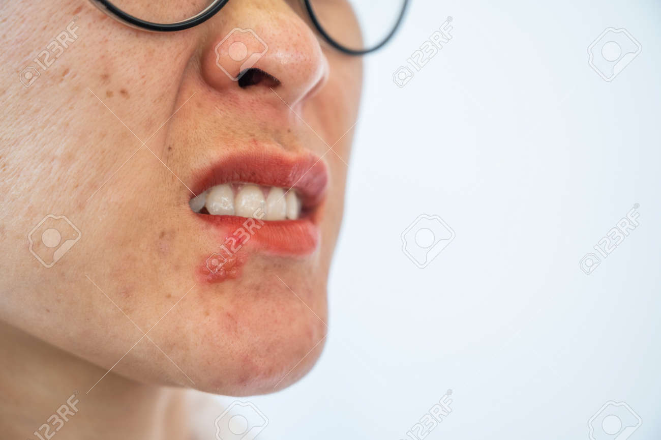 唇に白いブツブツができた際の適切な処置とはHanone ハノネ ～毎日キレイ 歯の本音メディア～