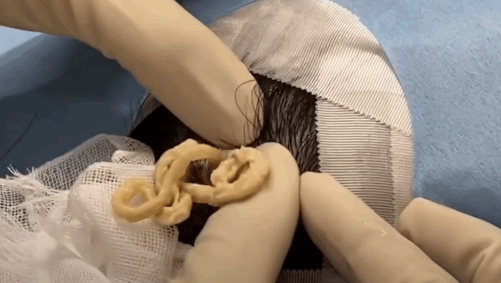 頭のできもの 炭酸ガスレーザーで治療した例 - あや皮フ科クリニックのblog