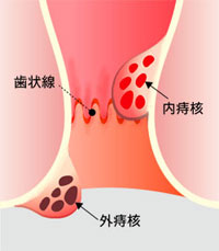 おしりの近くのできものの画像10選！ ぶよぶよの治し方は？医療法人中村会 堺なかむら総合クリニック