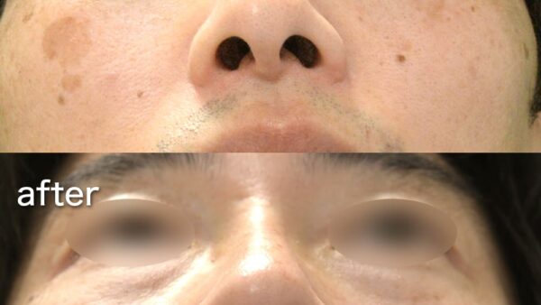 症例写真 斜鼻修正 曲がった鼻をまっすぐに の症例：美容外科 高須クリニック