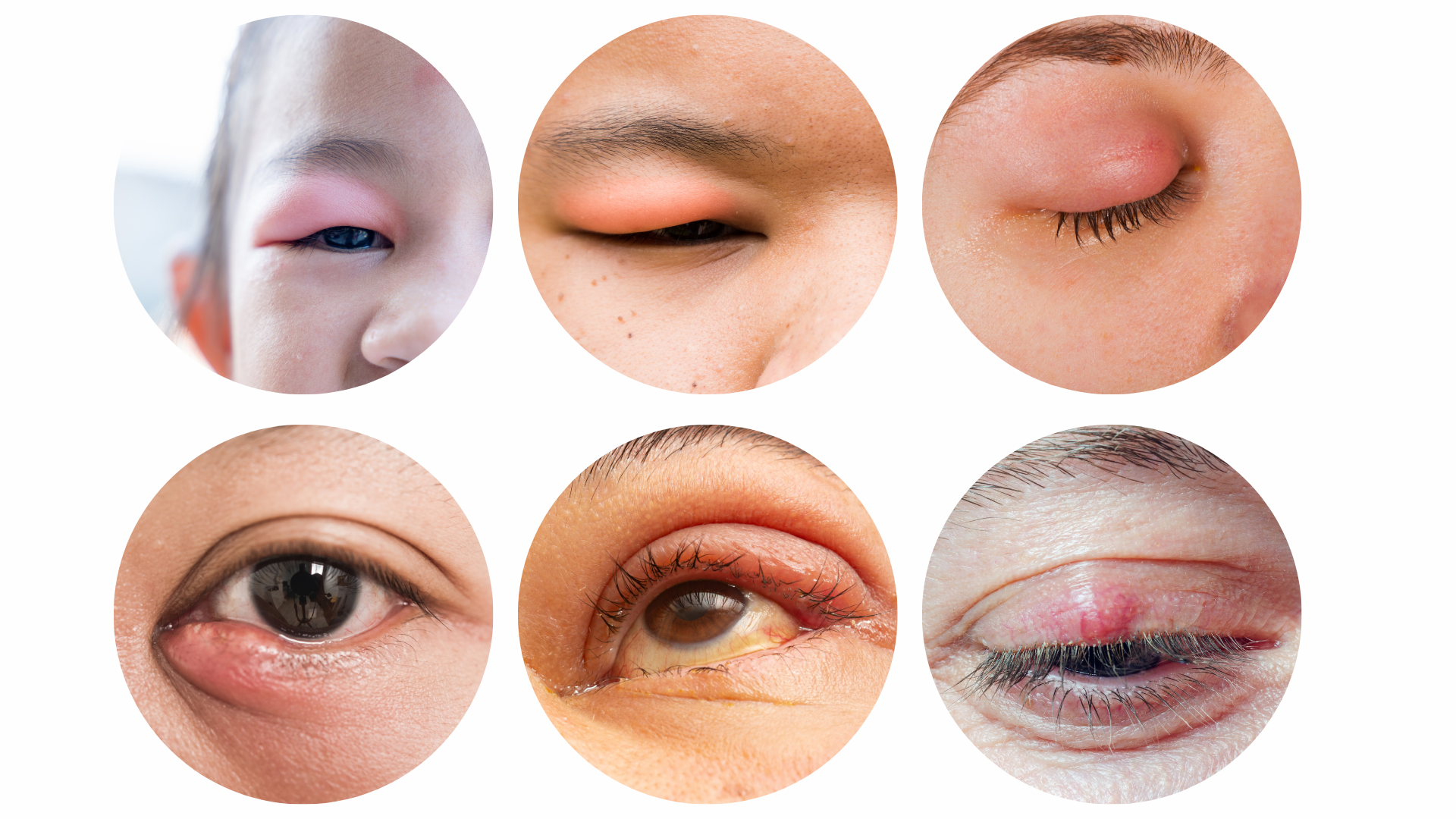 霰粒腫・麦粒腫 ものもらい -原因・症状・治療について川越眼科手術とまぶたのクリニック