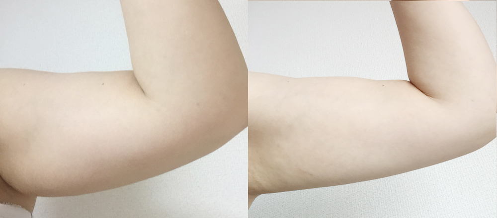 二の腕のセルライトはどう解消する？すっきり美腕への近道を紹介 - 銀座・名古屋・心斎橋の美肌治療は椿クリニック