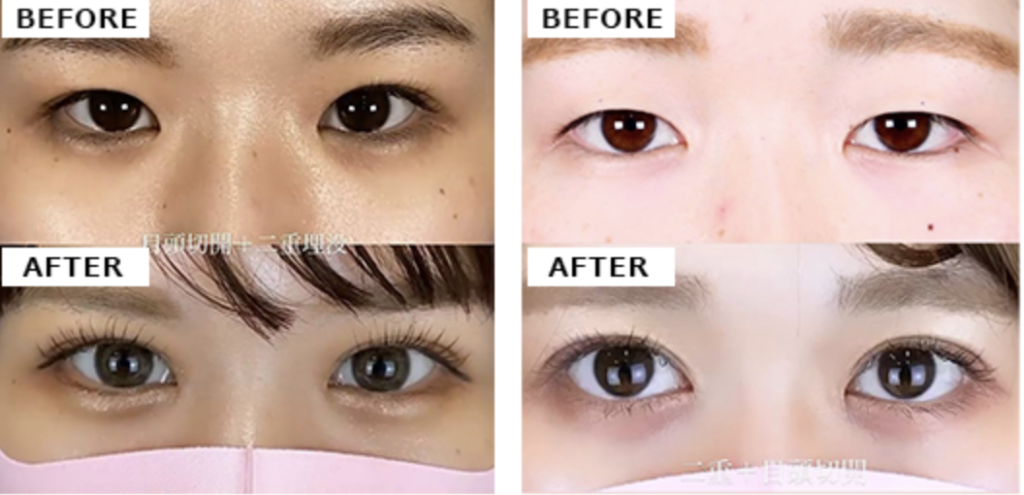 アイプチのし過ぎで瞼がたるんだ方必見！柴田院長による腫れない二重術埋没法 20代女性美容整形クリニックA CLINIC 公式