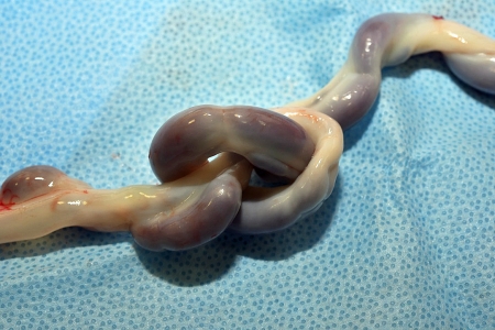 助産師監修 へその緒はとっておくべき？保管方法やポイントについてトモニテ