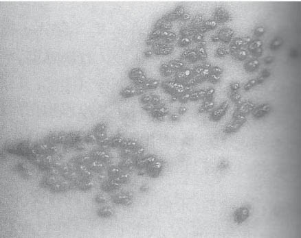 帯状疱疹の一例富山の鍼灸・筋膜整体 28年以上の実績 かない鍼灸整体院