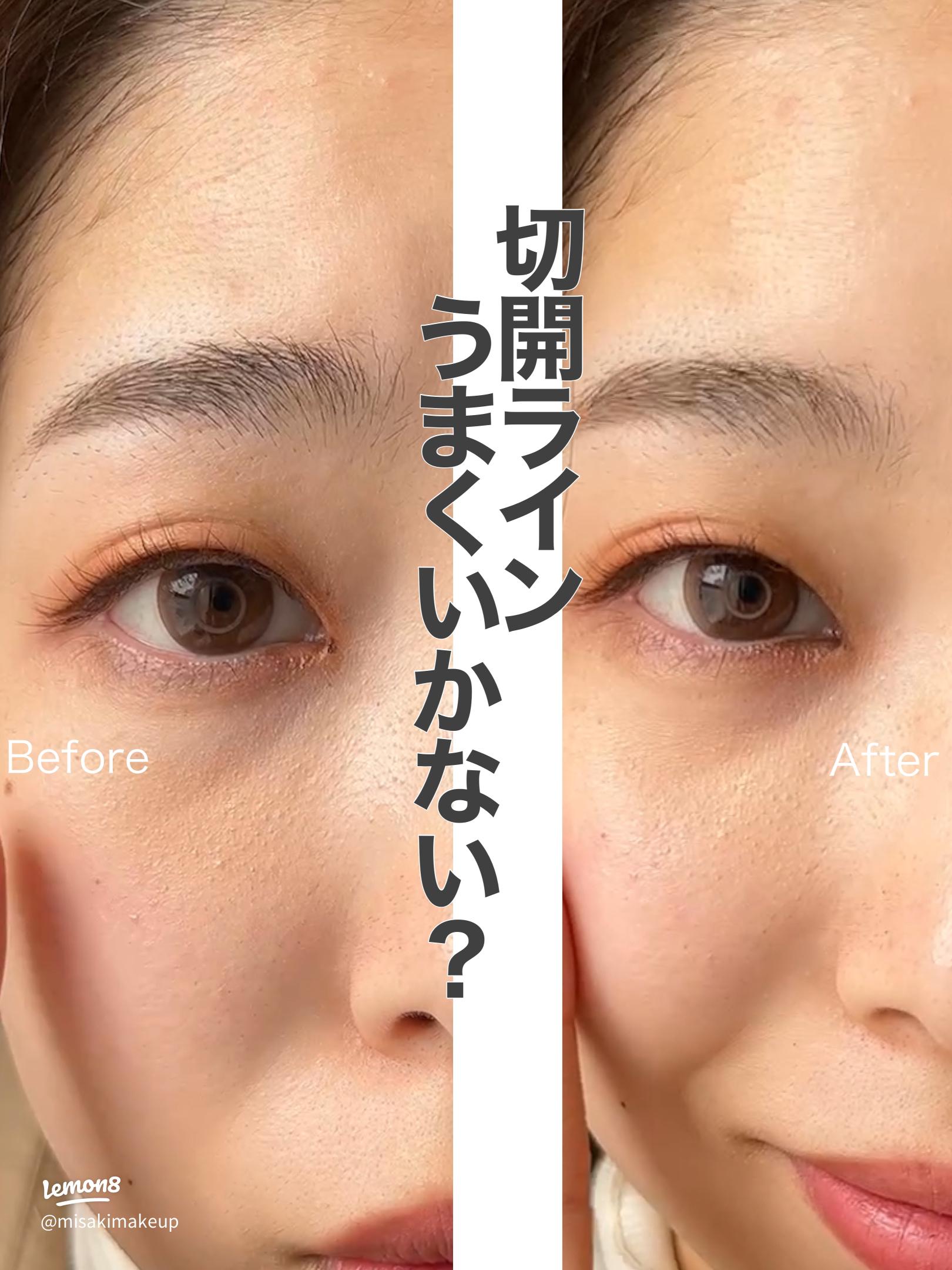 尖った蒙古襞と丸い蒙古襞の目頭切開のやり方！ そわんわん