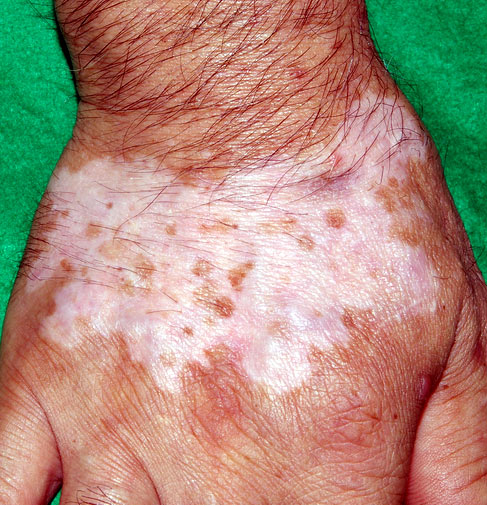 白斑の鍼灸 原因・定義・症状- 銀座そうぜん鍼灸院 深層筋・自律神経 銀座・築地