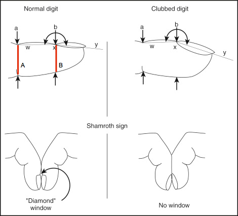 悩む人多数 ばち指の見分け方3選 原因疾患も解説